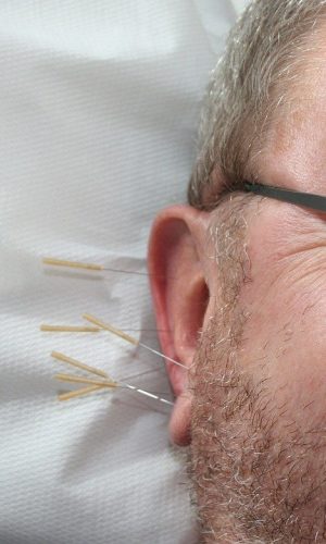 acupuncture-g654c91e30_1280
